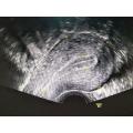 Probe Transvaginal Color Doppler